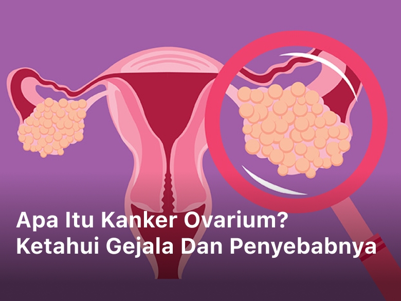 Apa itu Kanker Ovarium? Ketahui Gejala dan Penyebabnya