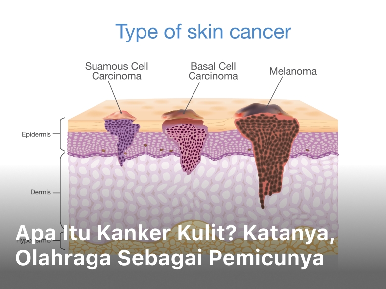 Apa itu kanker kulit; kanker kulit adalah; penyakit kanker kulit; kanker kulit; apa penyebab kanker kulit;