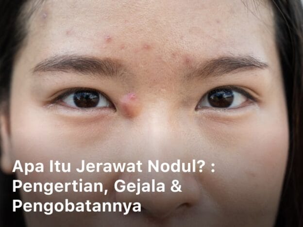 Apa Itu Jerawat Nodul; jerawat nodul; jenis jerawat nodul; jerawat nodul adalah; salep jerawat nodul; cara mengatasi jerawat nodul; cara menghilangkan jerawat nodul; nodul jerawat; penyebab jerawat nodul; skincare untuk jerawat nodul; cara mengempeskan jerawat nodul; ciri ciri jerawat nodul; jerawat nodul di dagu; jerawat nodul di payudara; jerawat nodul di pipi;